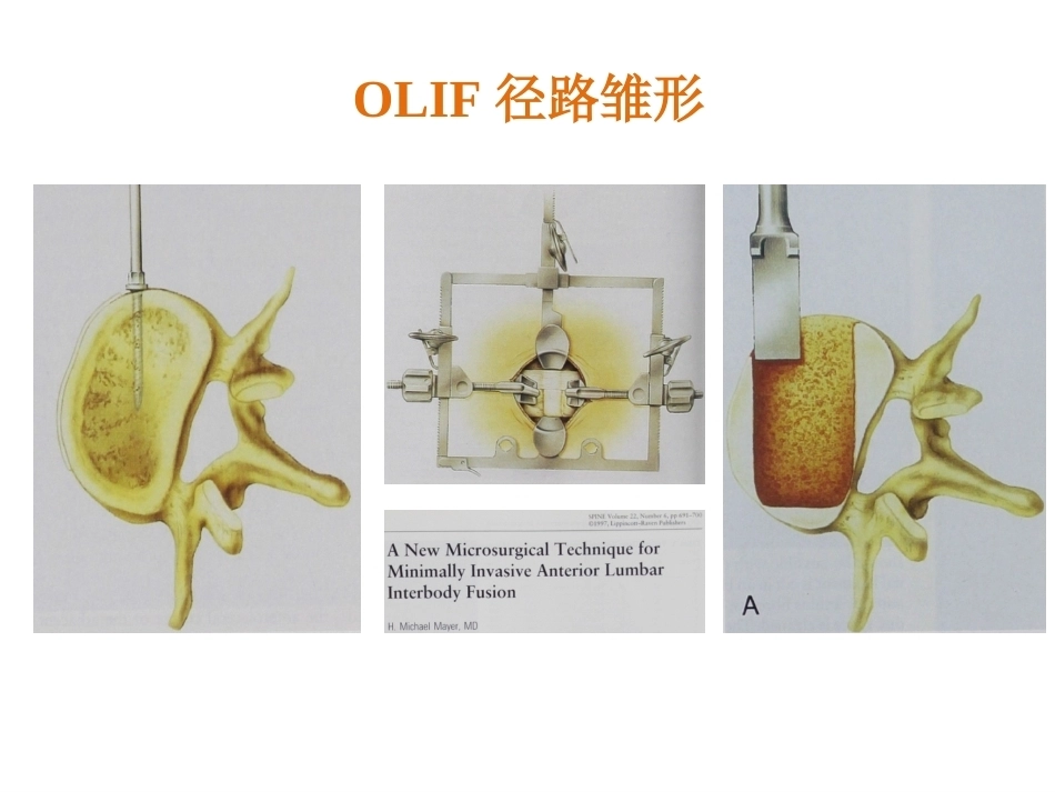 OLIF入路和相关解 剖_第10页