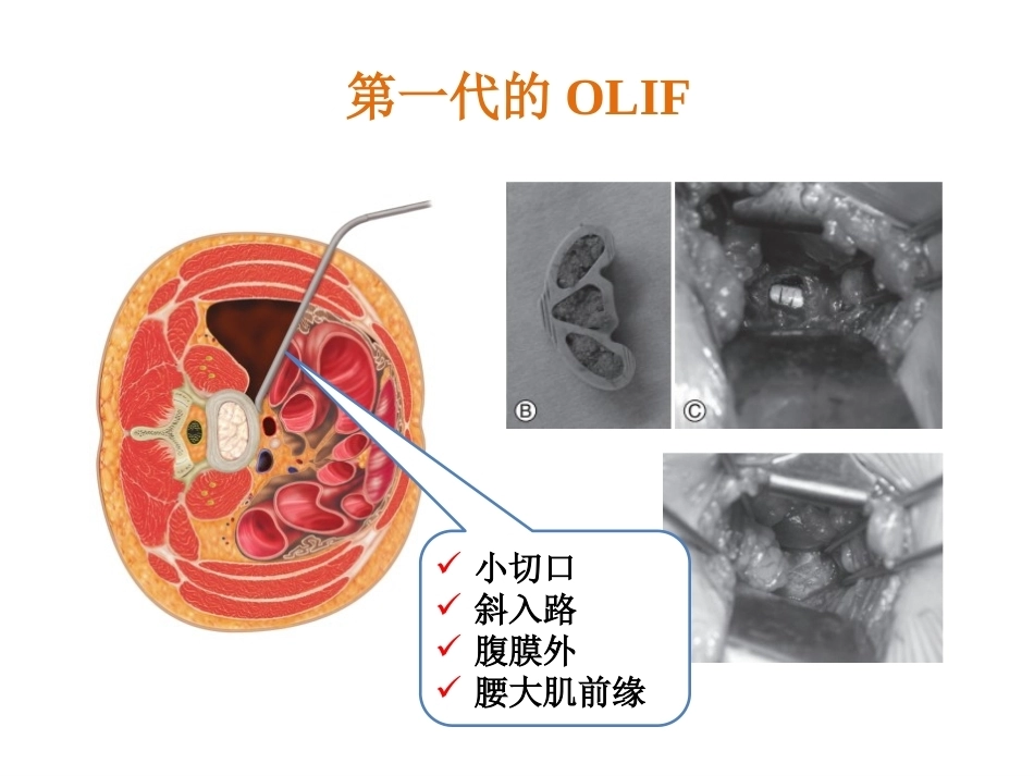 OLIF入路和相关解 剖_第11页