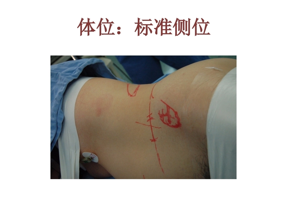 OLIF入路和相关解 剖_第14页
