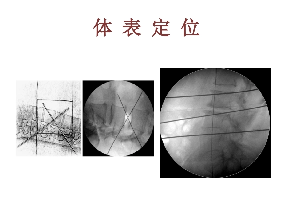OLIF入路和相关解 剖_第15页