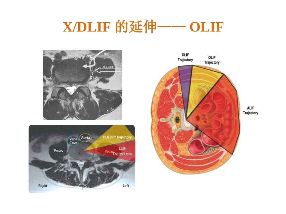 OLIF入路和相关解 剖_第9页