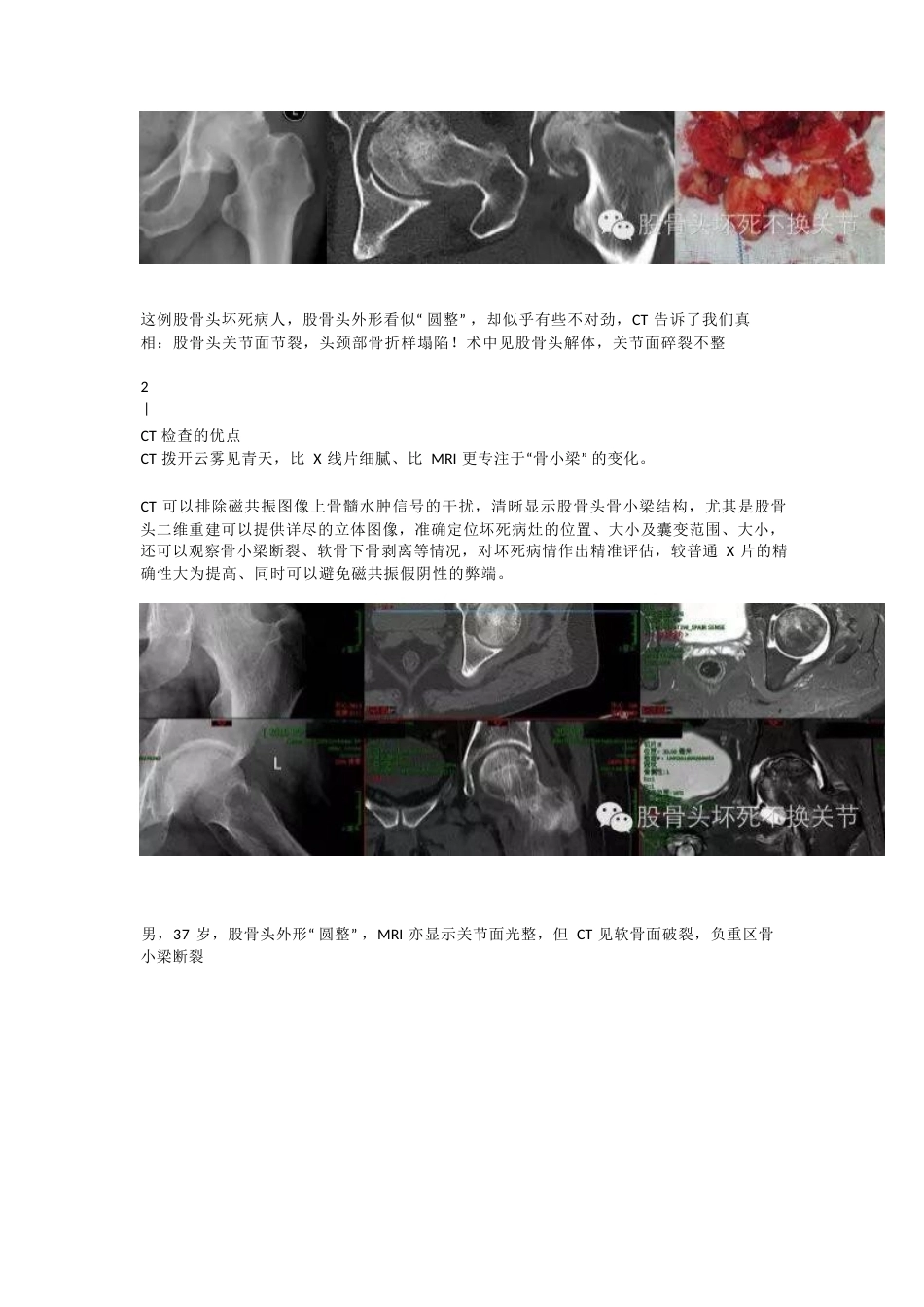 股骨头坏死应该怎样 做检查_第10页