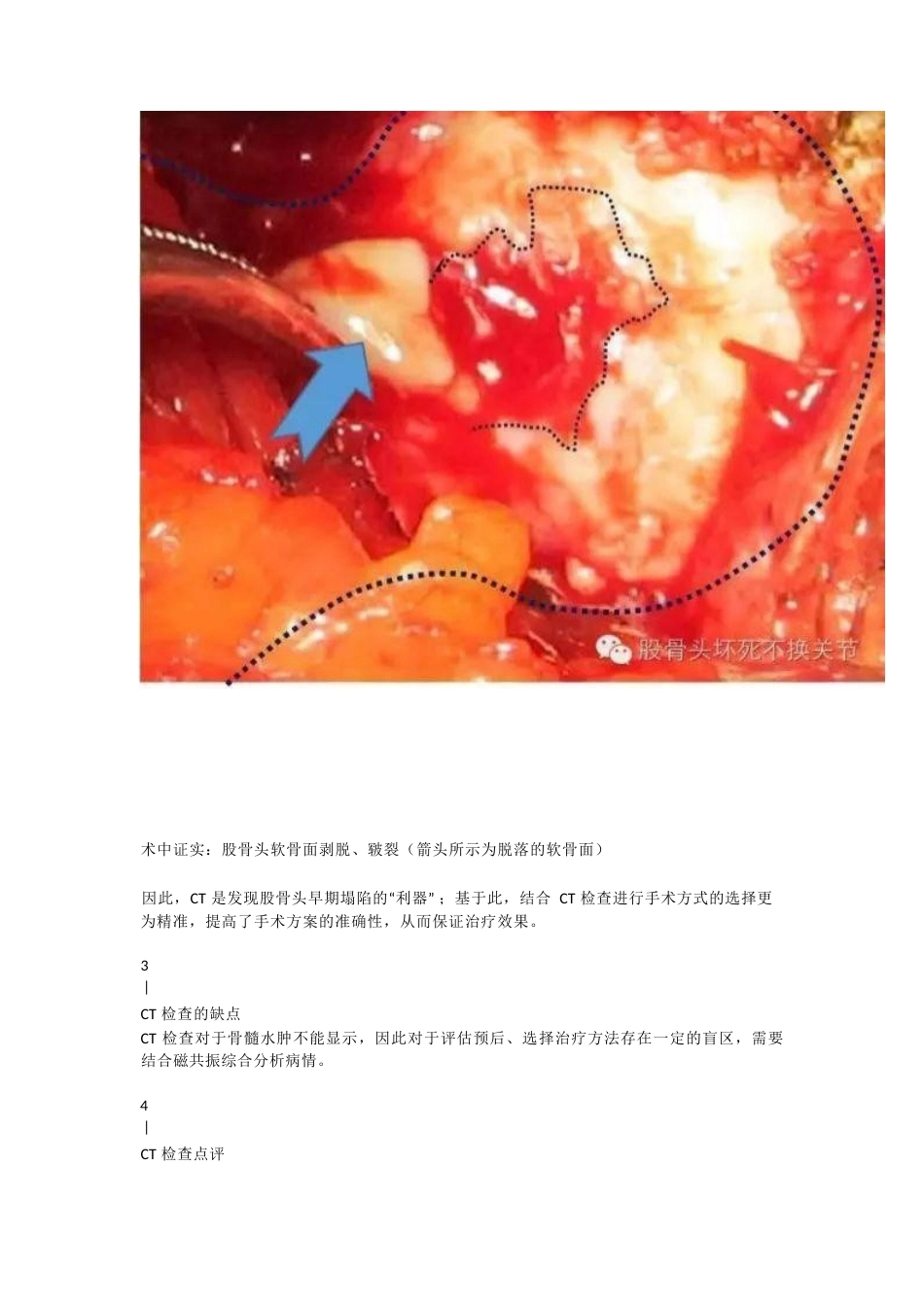 股骨头坏死应该怎样 做检查_第11页