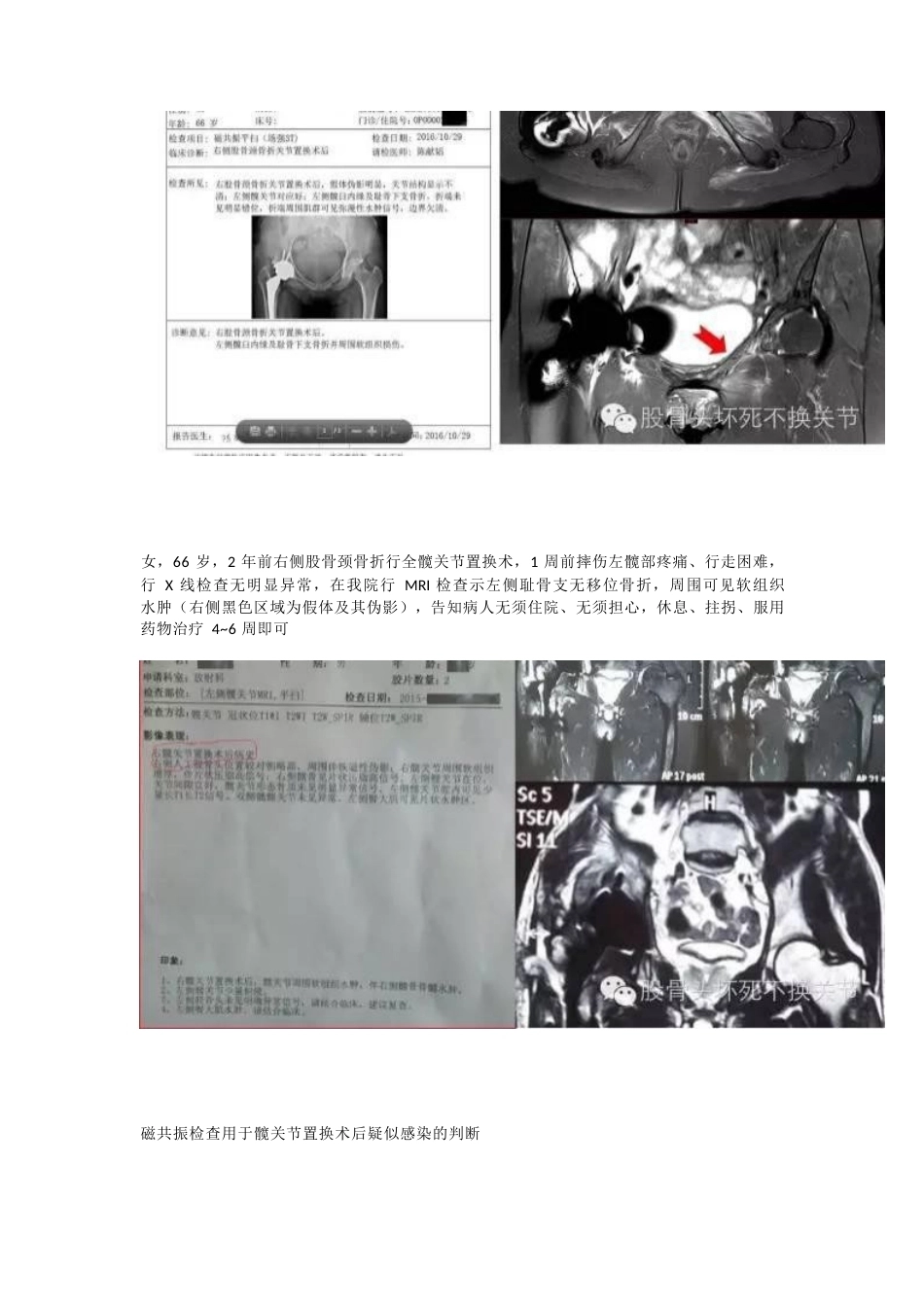 股骨头坏死应该怎样 做检查_第8页