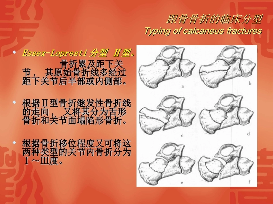 跟骨骨折的分型与治疗_第12页
