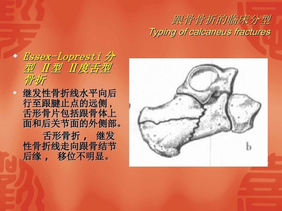 跟骨骨折的分型与治疗_第14页