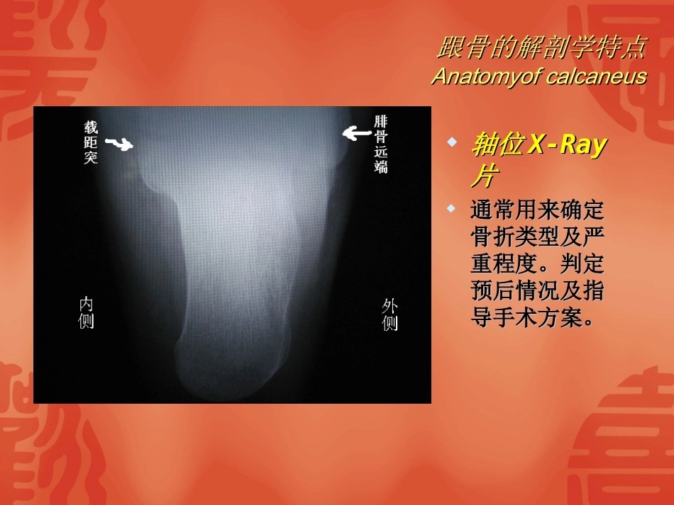 跟骨骨折的分型与治疗_第4页