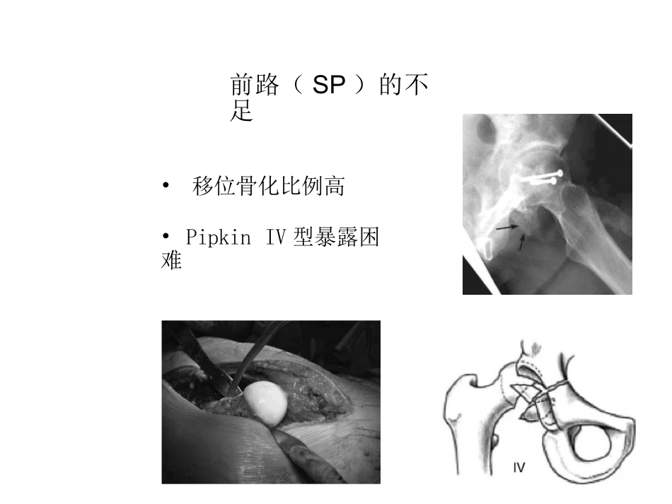 股骨头骨折入路选择_第15页