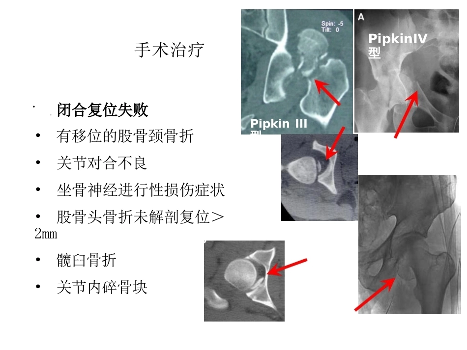 股骨头骨折入路选择_第6页