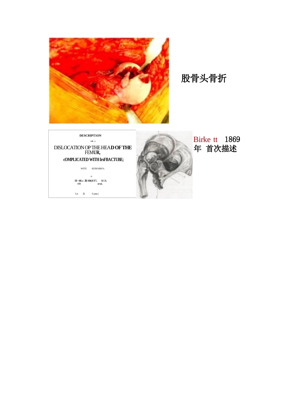 股骨头骨折的手 术入路及方法_第1页