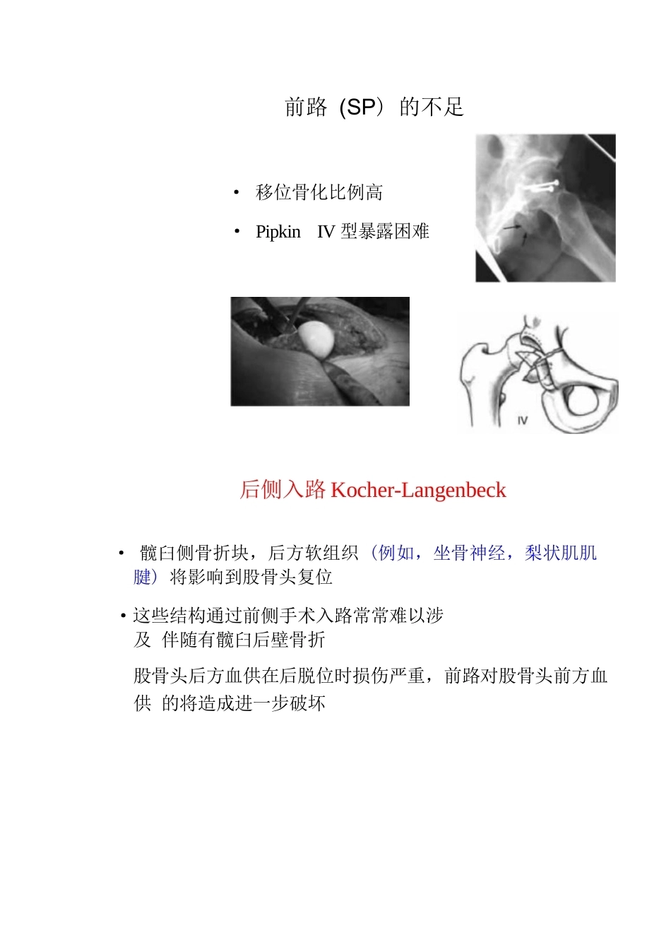 股骨头骨折的手 术入路及方法_第11页