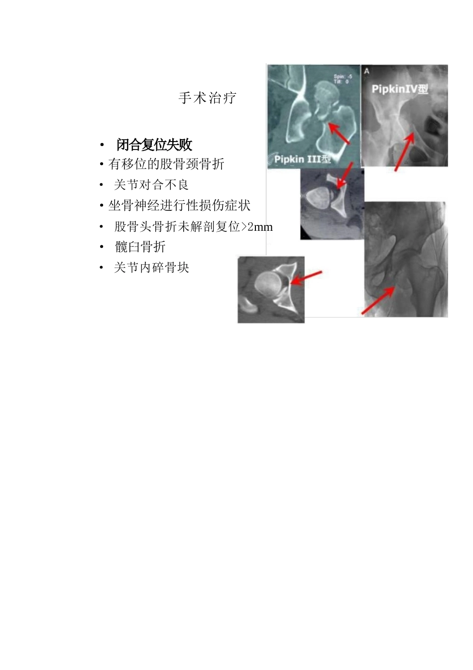 股骨头骨折的手 术入路及方法_第4页