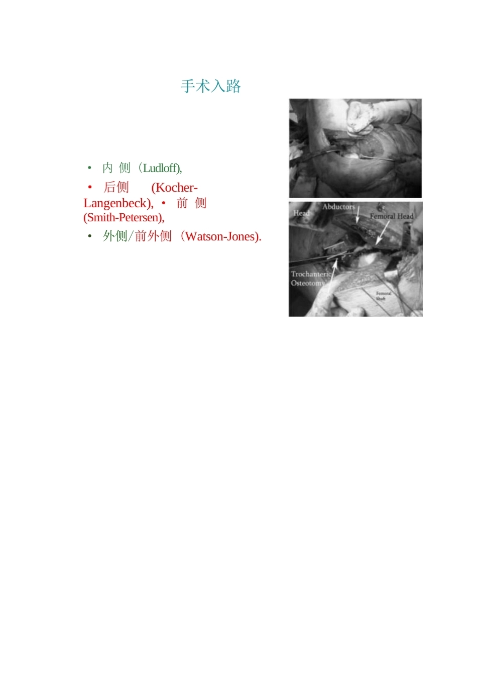 股骨头骨折的手 术入路及方法_第5页