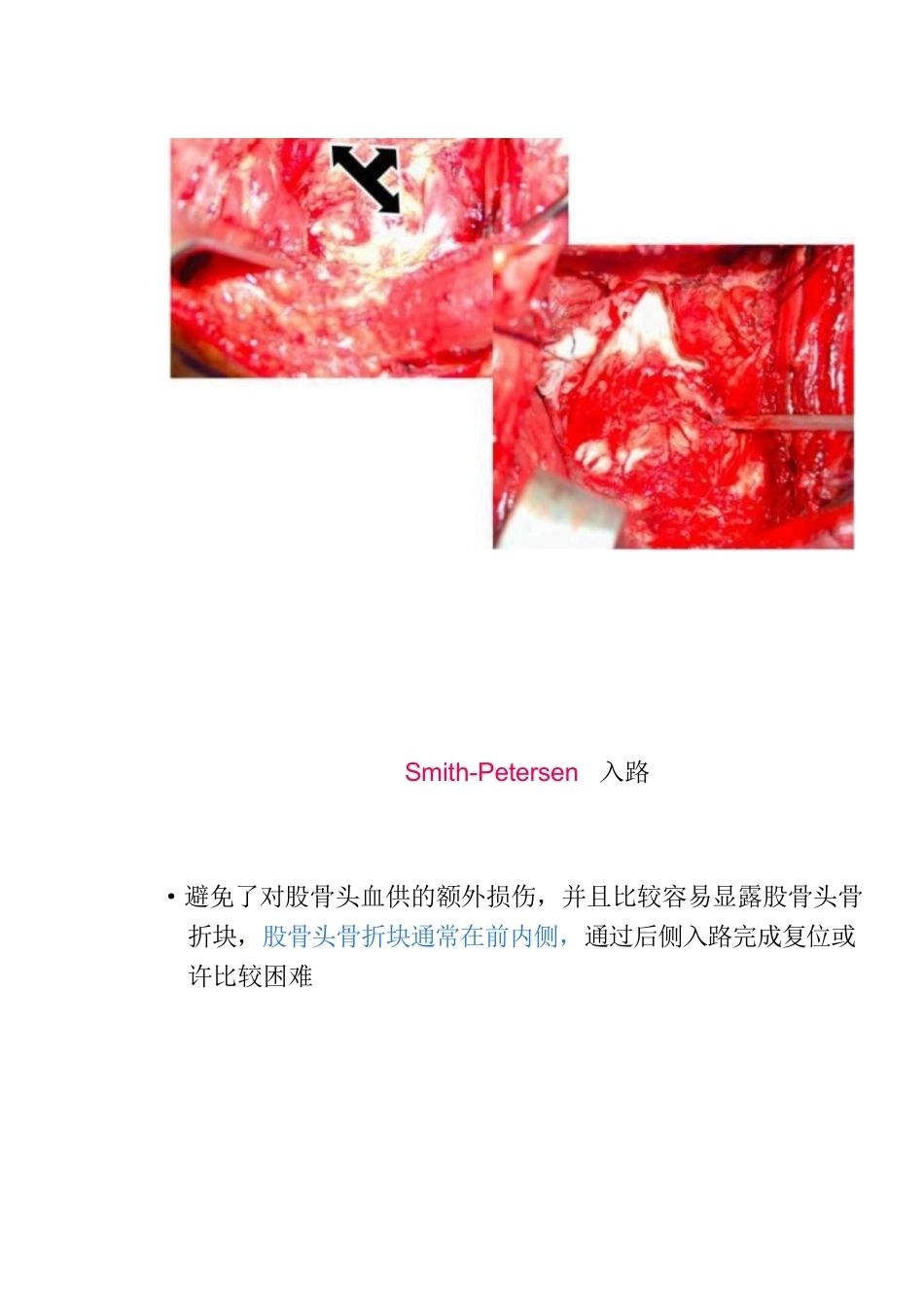 股骨头骨折的手 术入路及方法_第9页