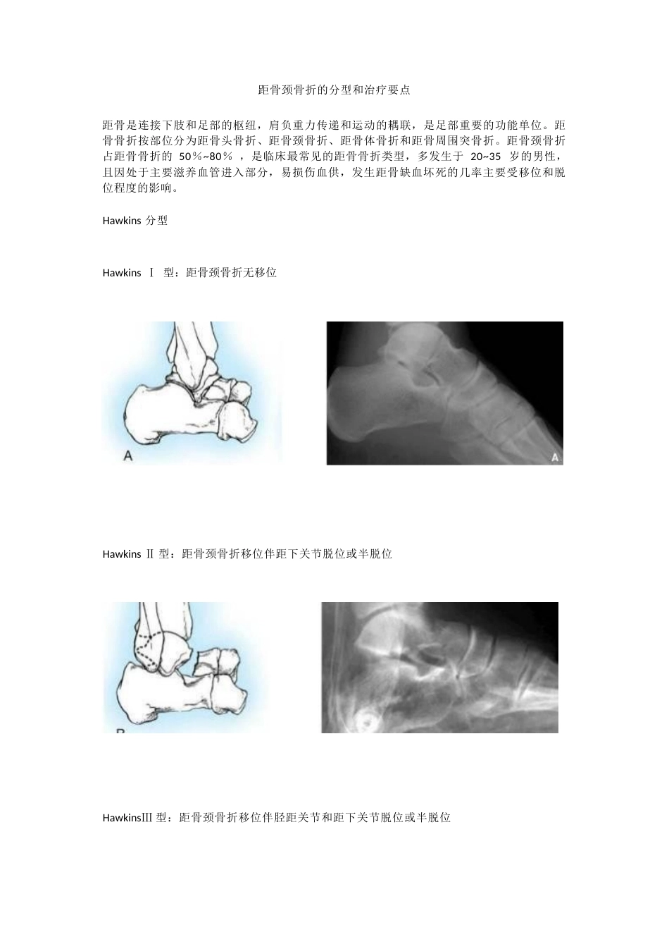 距骨颈骨折的分型_第1页