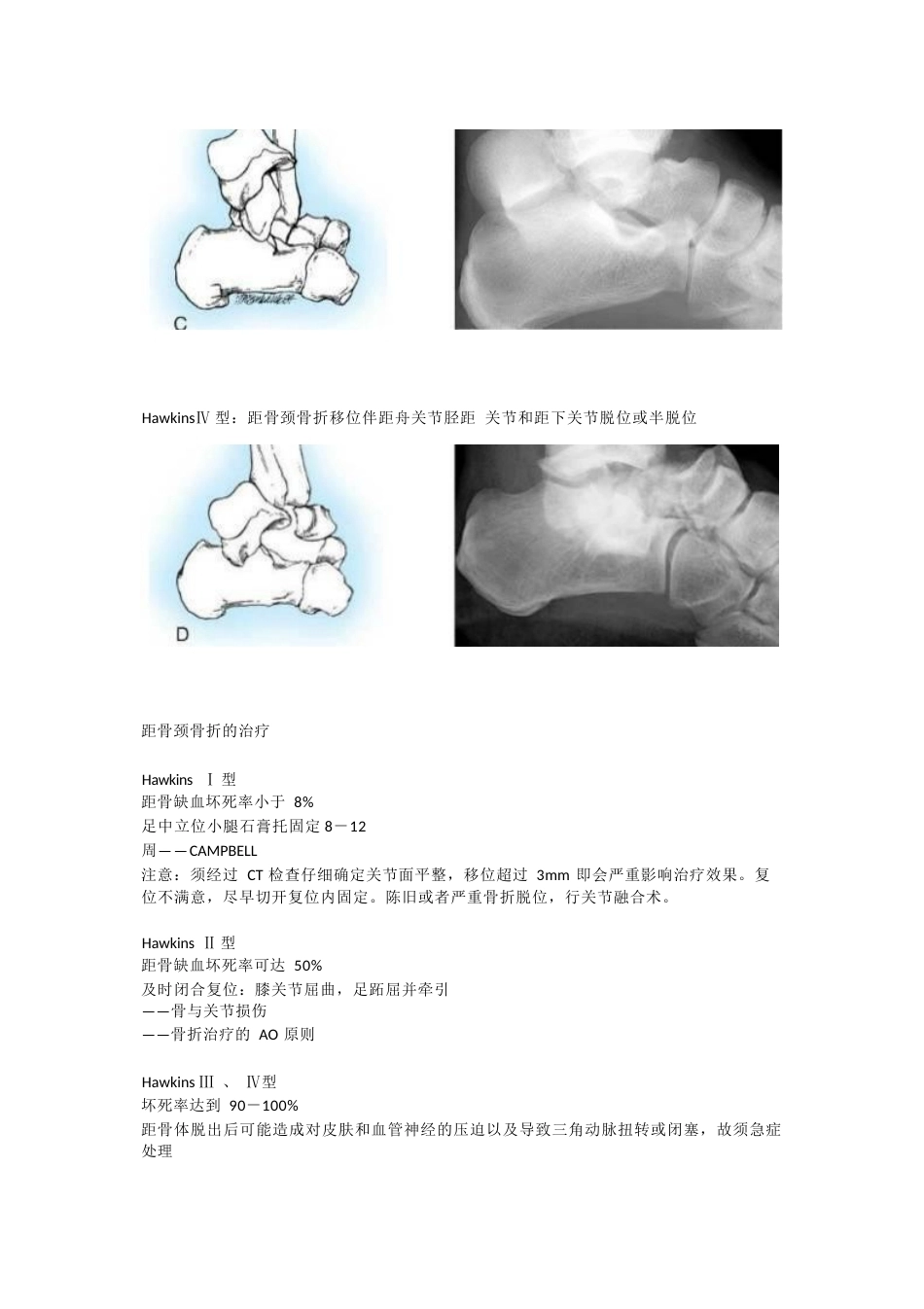 距骨颈骨折的分型_第2页