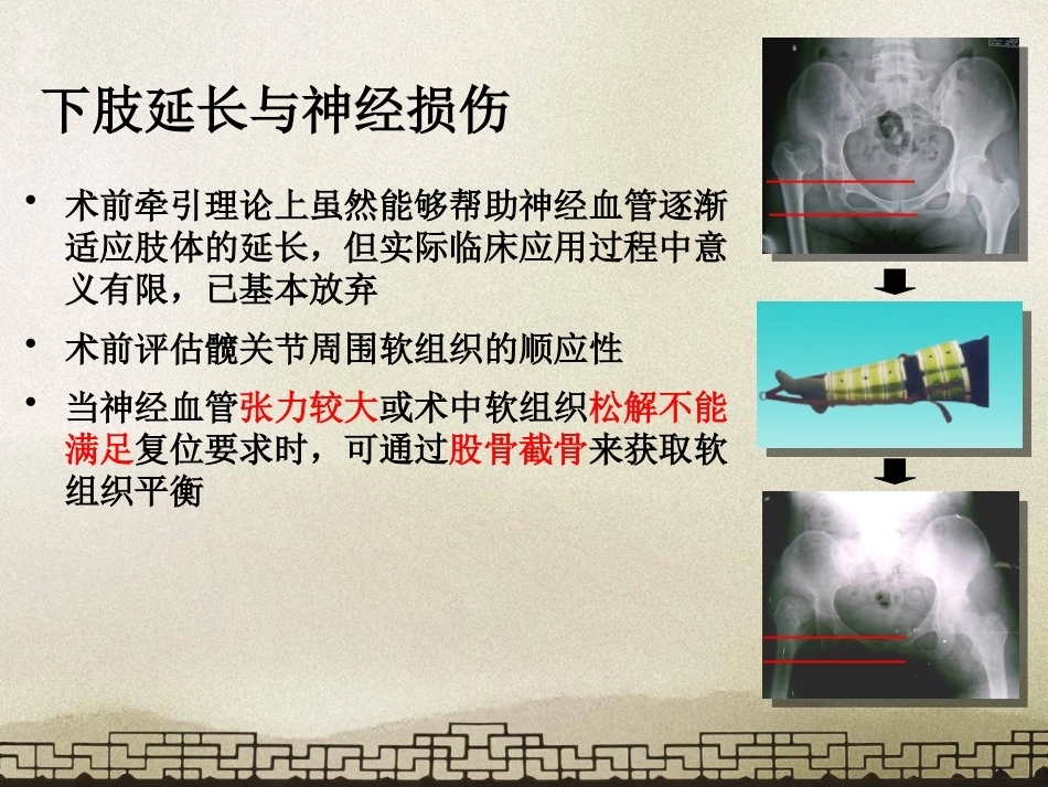 采取转子 间截骨治疗严重成人髋关节发育不良_第11页