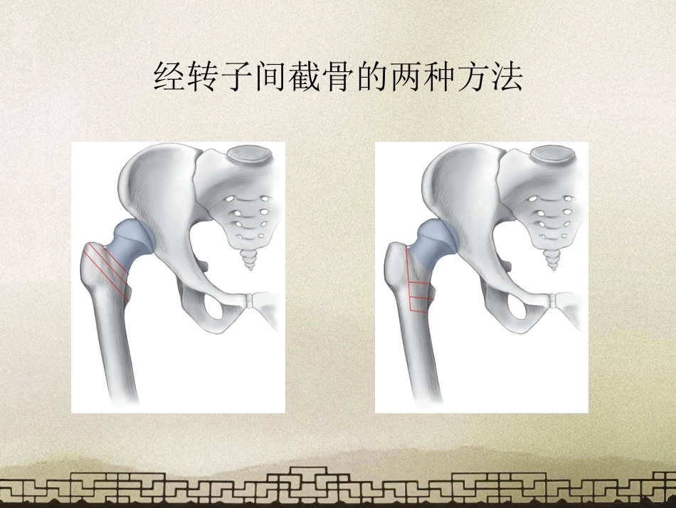 采取转子 间截骨治疗严重成人髋关节发育不良_第15页