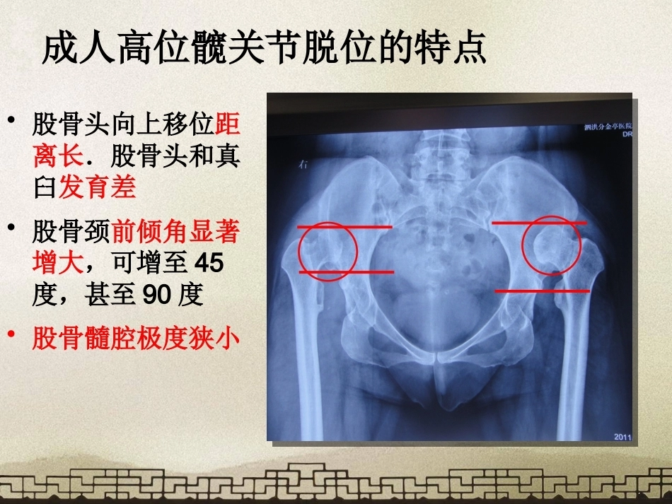 采取转子 间截骨治疗严重成人髋关节发育不良_第3页