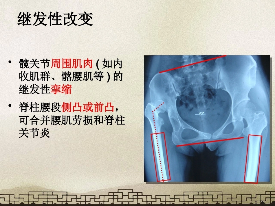 采取转子 间截骨治疗严重成人髋关节发育不良_第4页