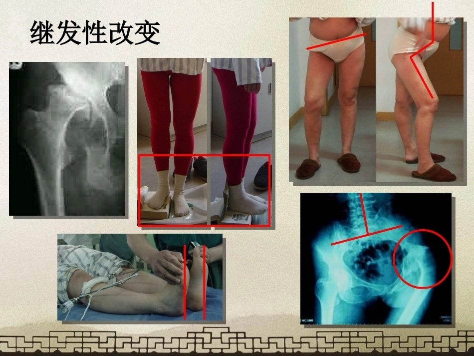 采取转子 间截骨治疗严重成人髋关节发育不良_第5页