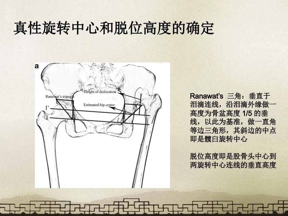 采取转子 间截骨治疗严重成人髋关节发育不良_第8页