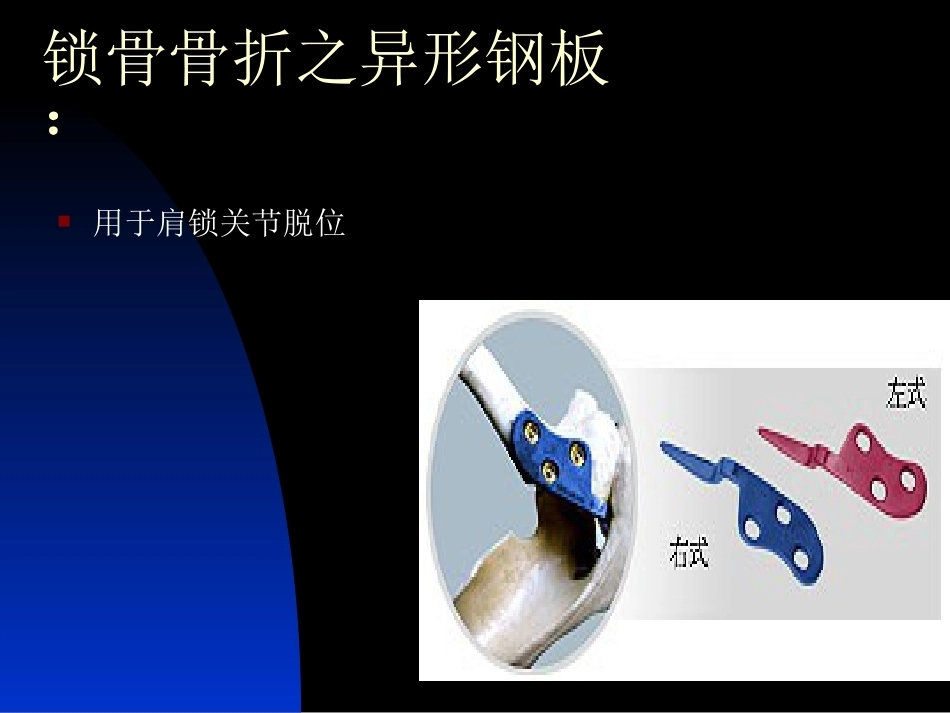 骨科常用内固定器械_第14页