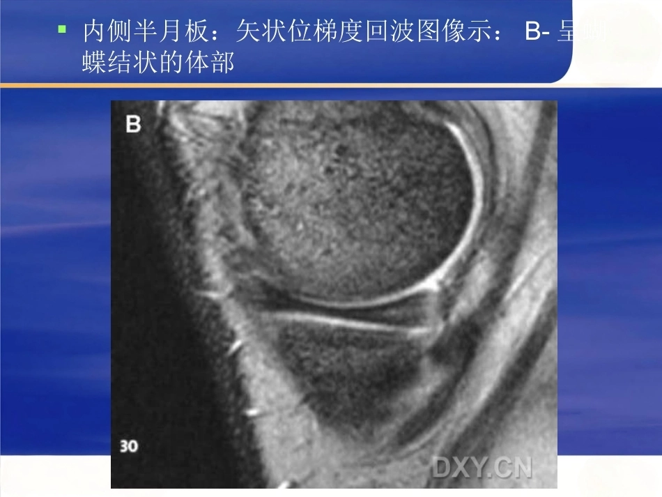 膝关节MRI 解剖及损伤_第10页
