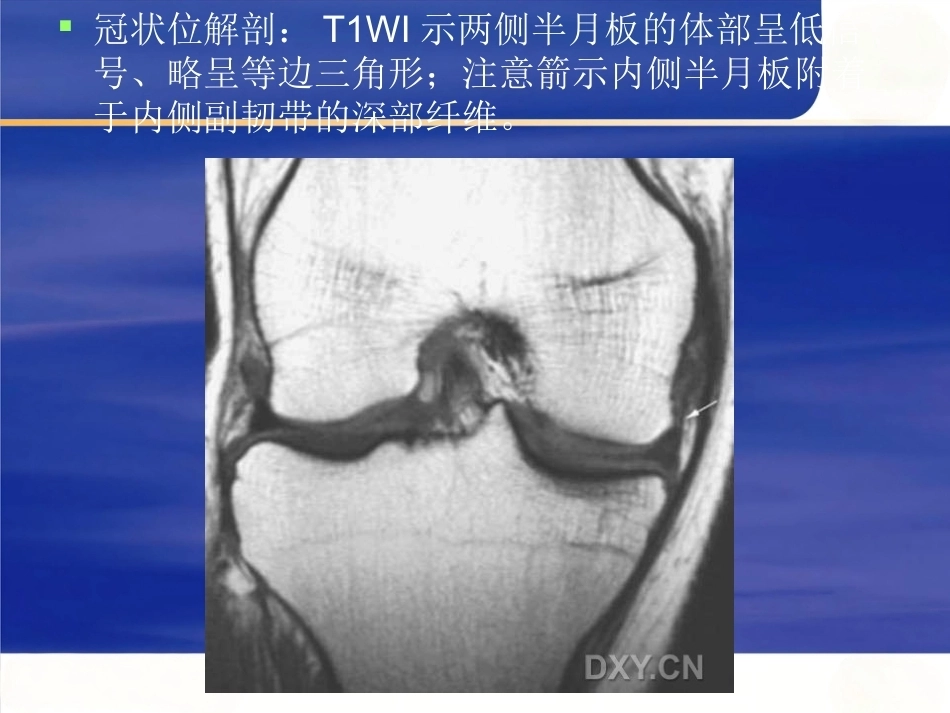 膝关节MRI 解剖及损伤_第11页