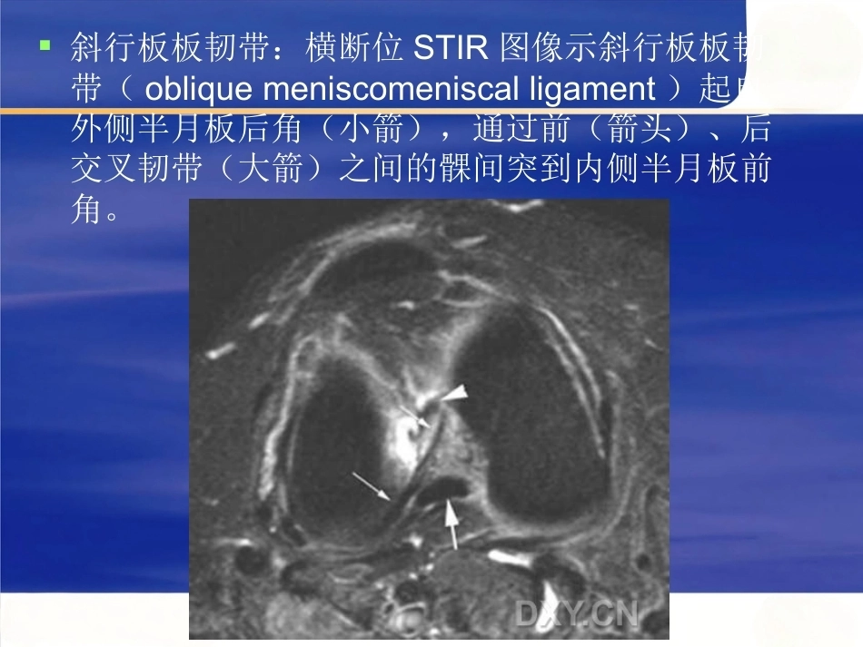 膝关节MRI 解剖及损伤_第12页
