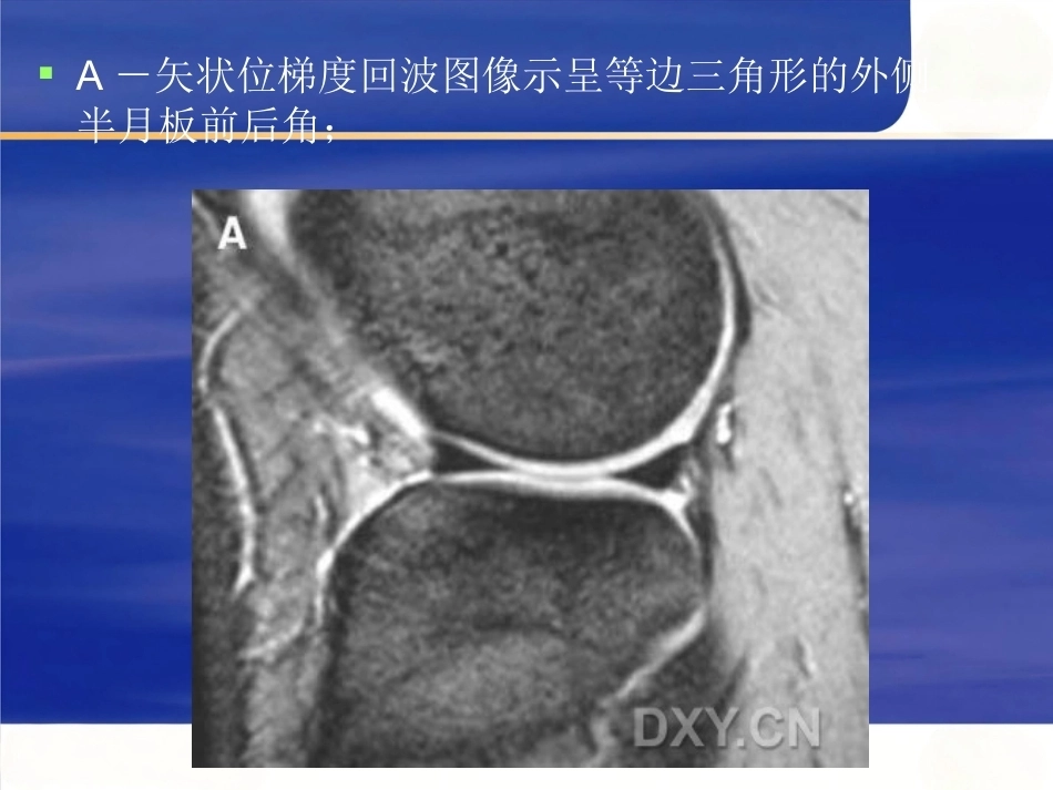 膝关节MRI 解剖及损伤_第14页