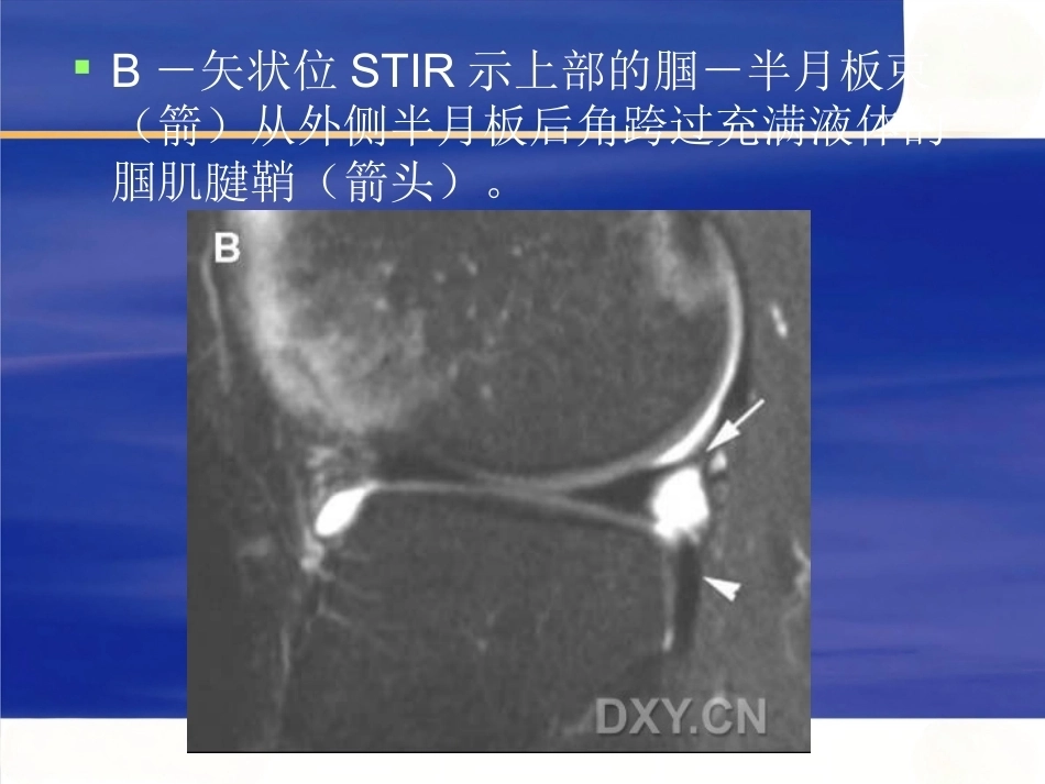 膝关节MRI 解剖及损伤_第15页