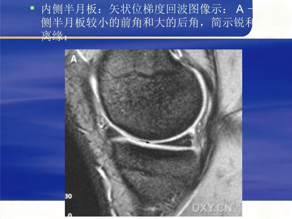膝关节MRI 解剖及损伤_第9页