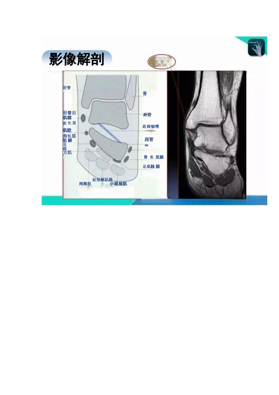 踝关节的急性损伤机制与分型_第11页