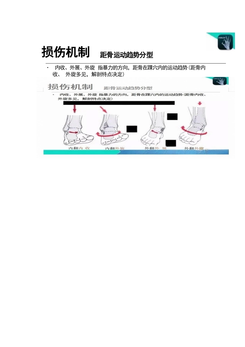 踝关节的急性损伤机制与分型_第14页