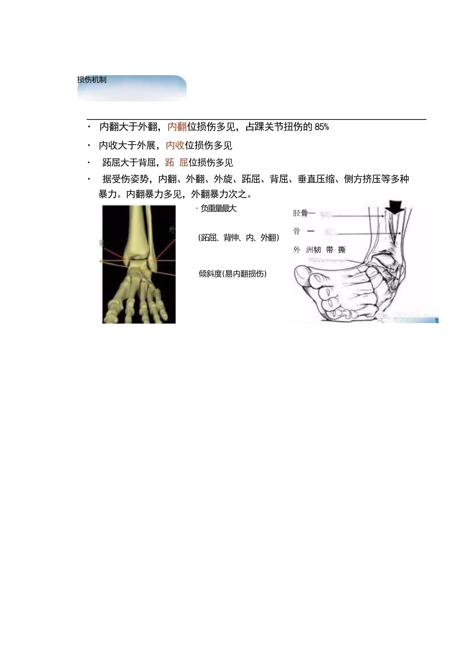 踝关节的急性损伤机制与分型_第15页