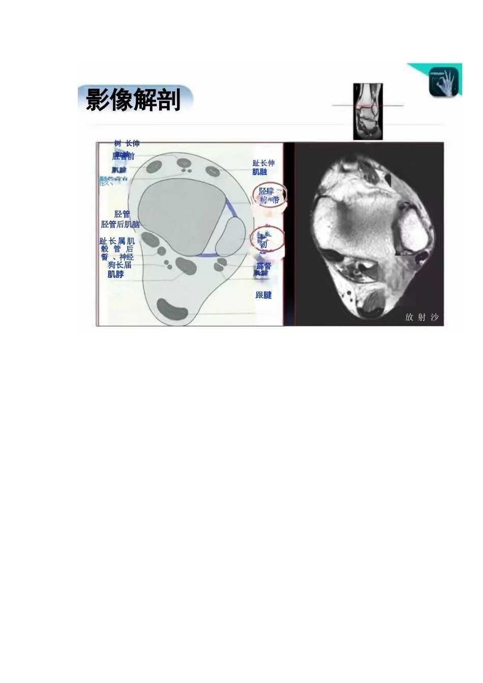 踝关节的急性损伤机制与分型_第8页