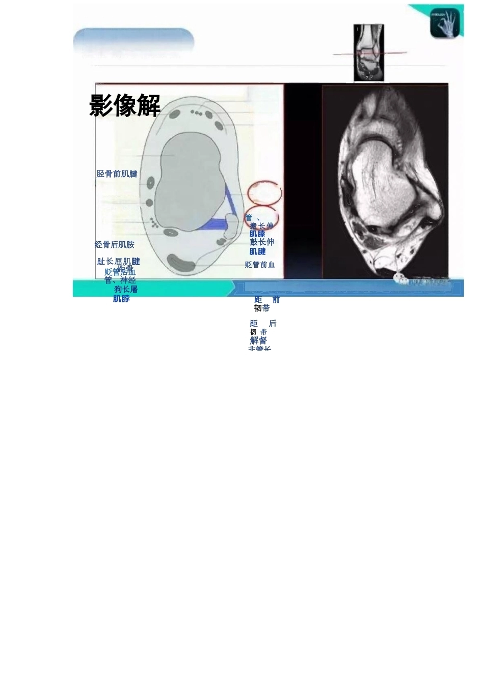 踝关节的急性损伤机制与分型_第9页