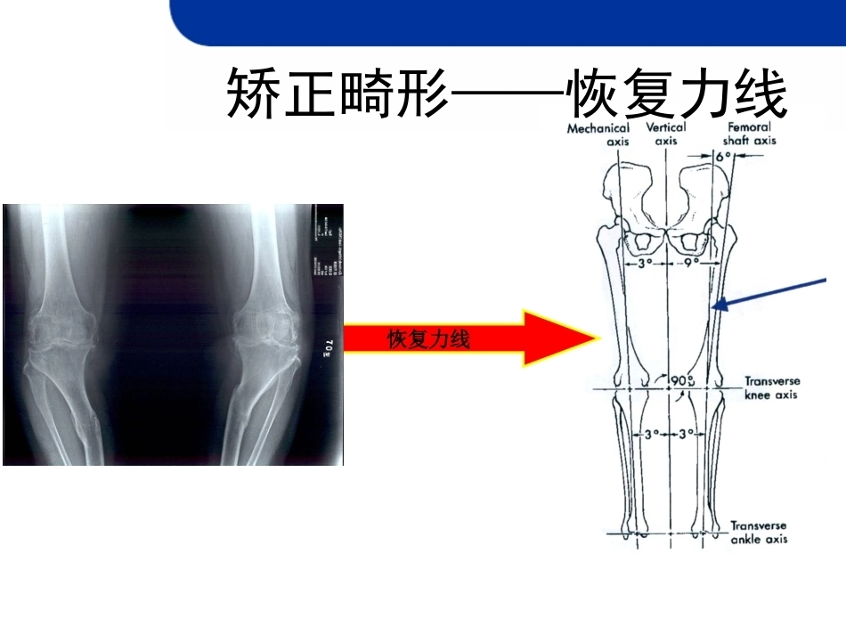 全膝 关节置换的截骨原则_第4页