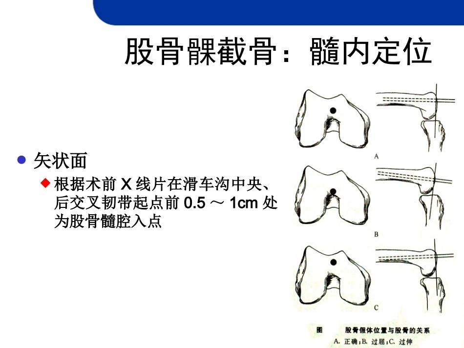 全膝关节置 换的截骨原则_第11页