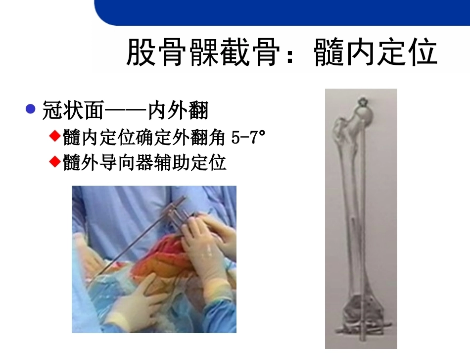 全膝关节置 换的截骨原则_第12页