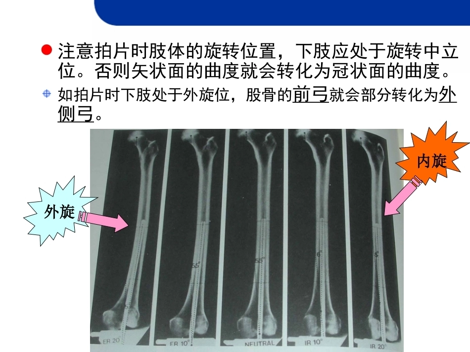 全膝关节置 换的截骨原则_第14页