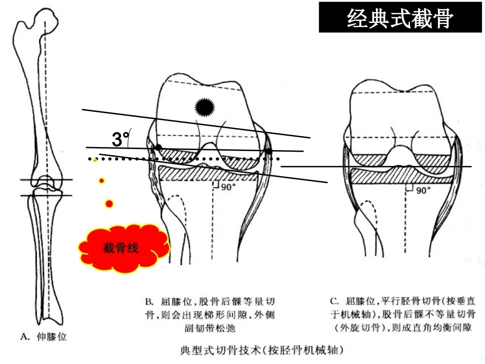 全膝关节置 换的截骨原则_第9页