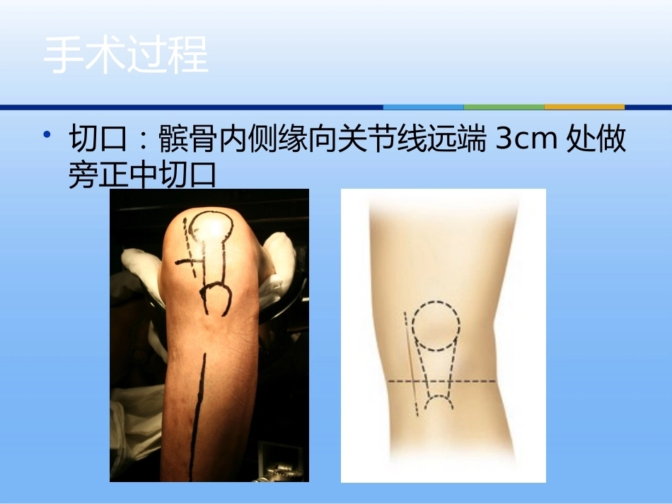 膝关节单髁 置换_第12页