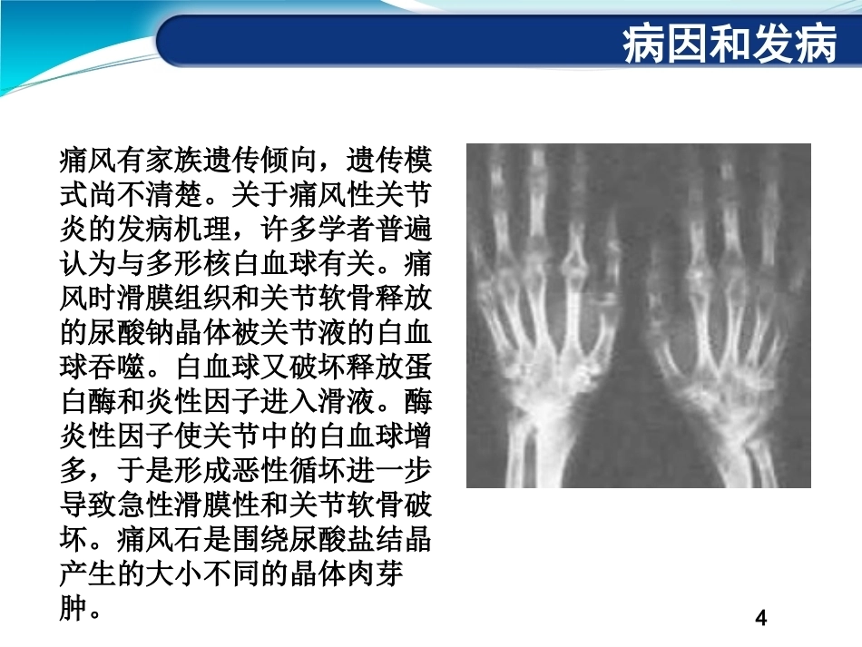 痛风性关节 炎_第4页