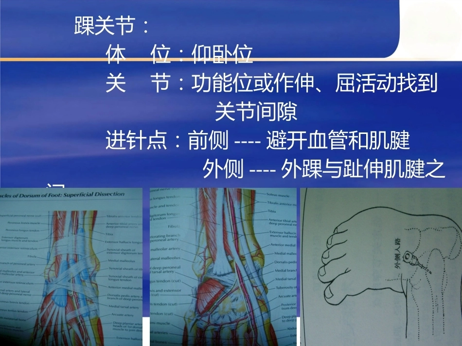 最新关节穿 刺术_第11页