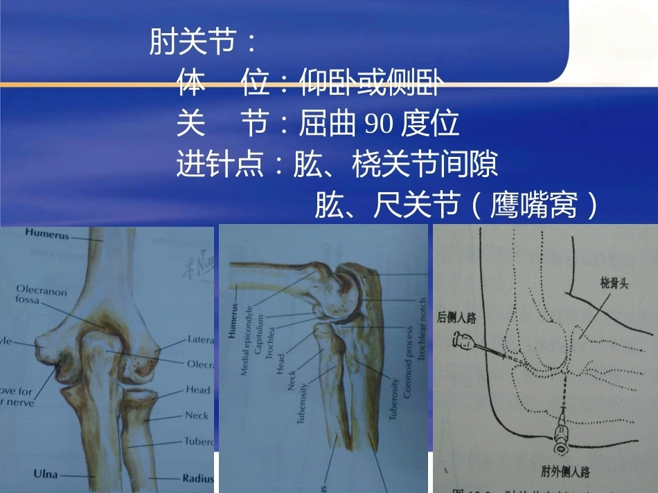 最新关节穿 刺术_第12页