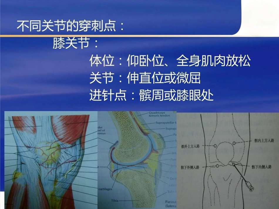最新关节穿 刺术_第4页