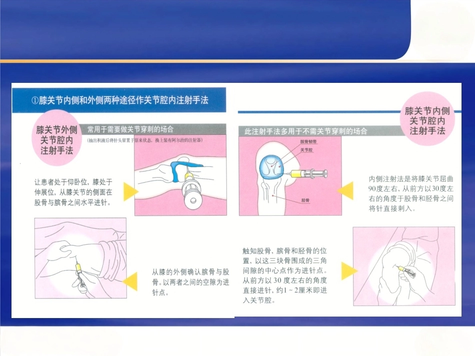 最新关节穿 刺术_第5页