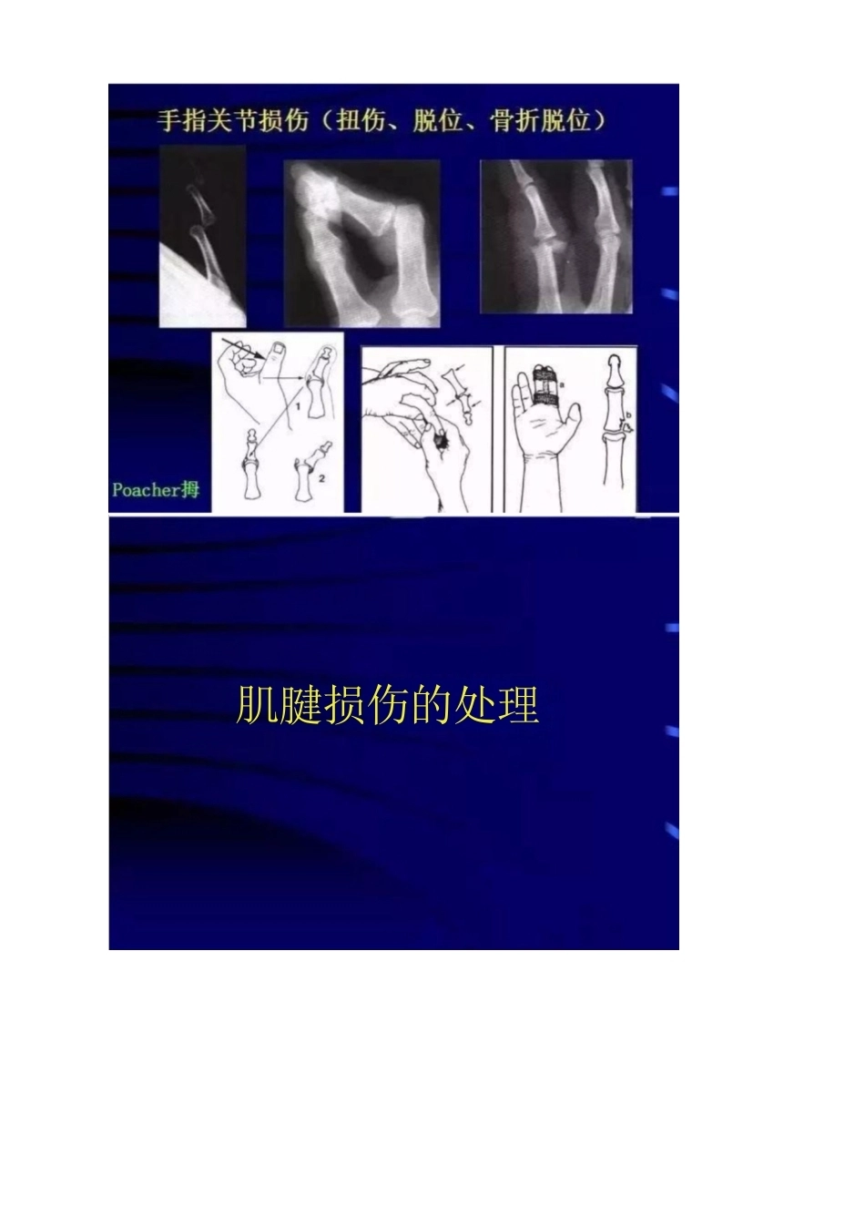 手外伤的常见处理 策略及要点_第9页